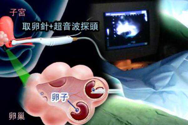 武汉医院可以借卵生子 2023武汉人工受孕费用参考 ‘看男女最准的方法b超’